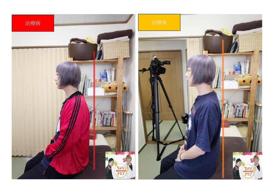 ホシノ式骨盤調整　取材